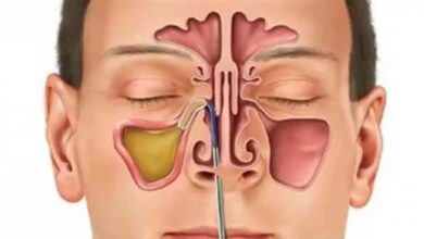 طريقة مبتكرة لعلاج الجيوب الأنفية دون الحاجة للأدوية